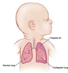 Pneumothorax